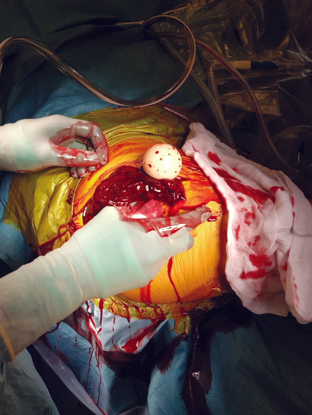 Den lukserede liner, der kom til syne i operationsfeltet med koaguleret blod efter gennembrydning af fascien.