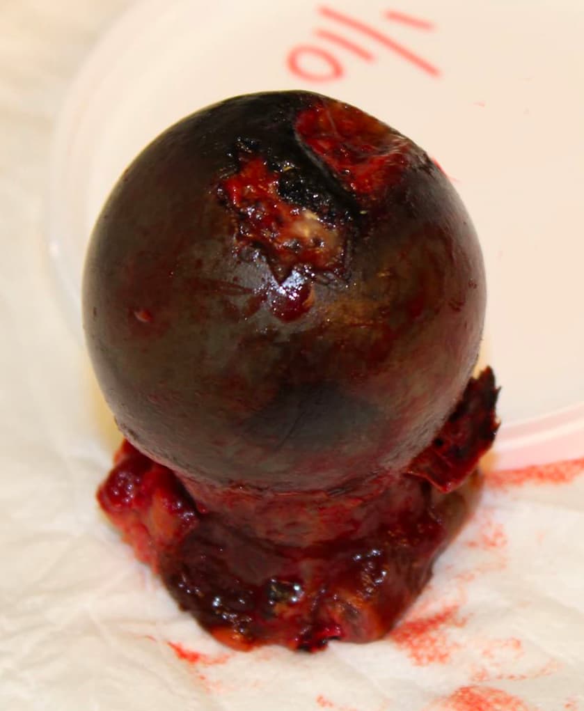 Sort caput femoris fjernet under hoftealloplastik. Læg mærke til bruskdefekten.