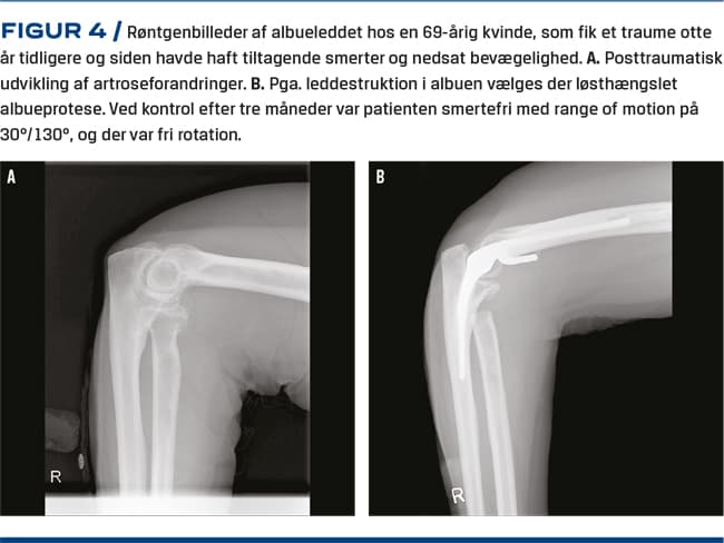 Skulder-, albue- og akromioklavikulærartrose Ugeskriftet.dk