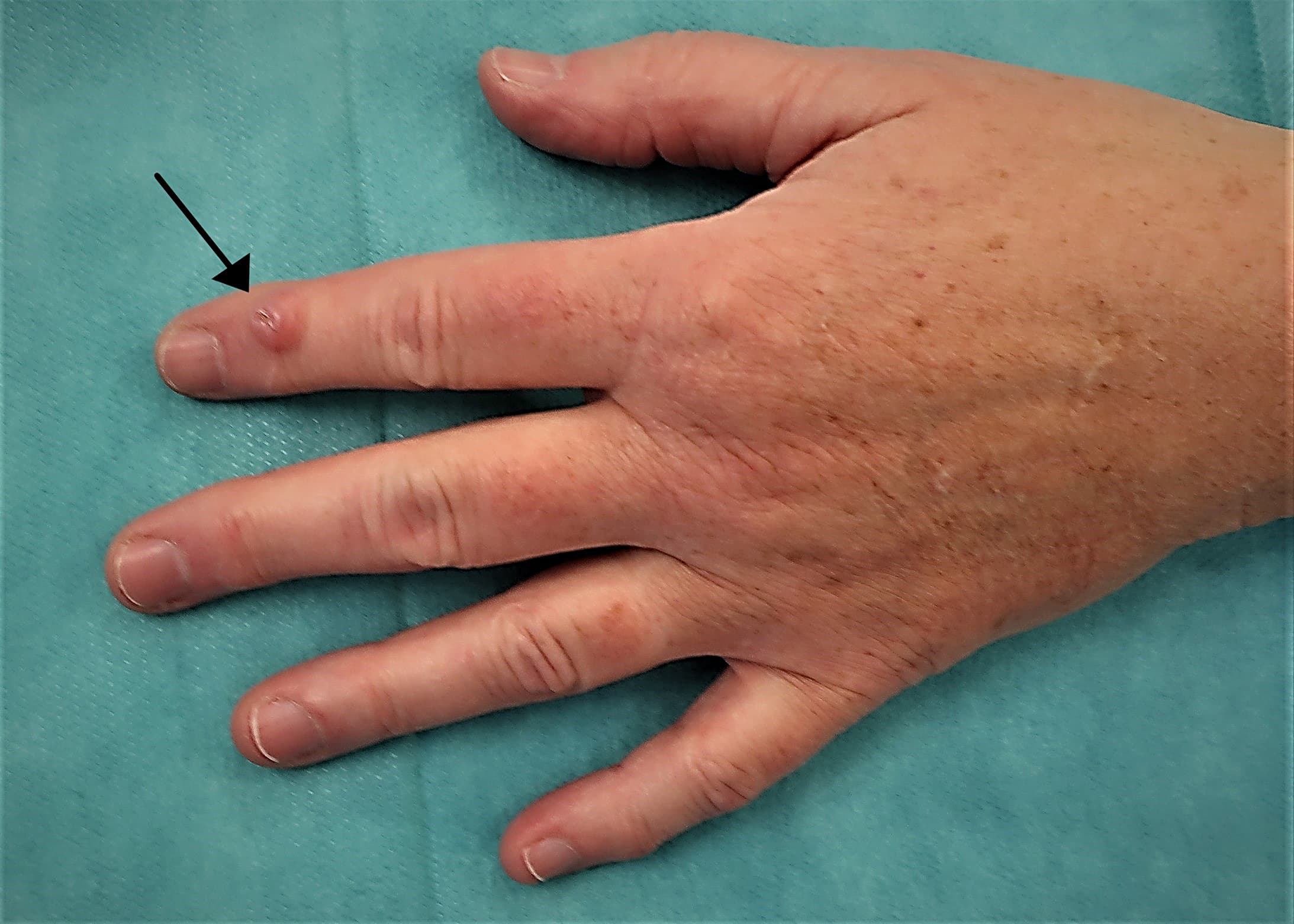 Mukoidcyste på anden finger.