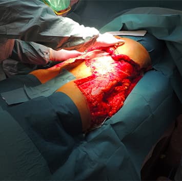 Patient efter revision af nekrotiserende bløddelsinfektion på truncus.