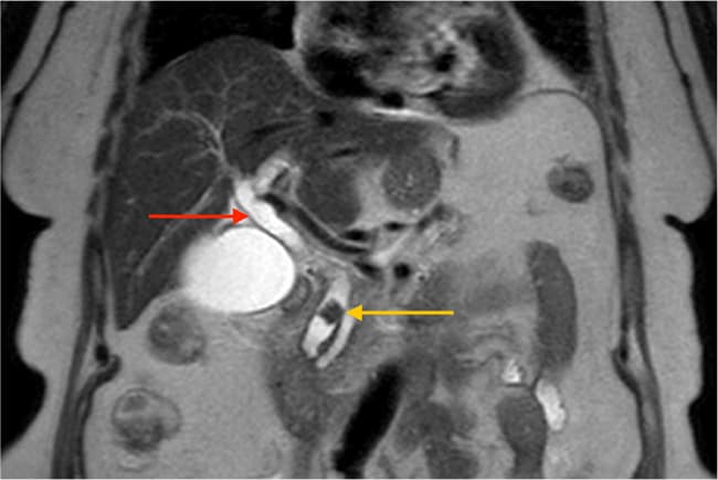 MR-kolangiopankreatografi, som viser tydeligt dilateret ductus choledochus (rød pil) med fyldningsdefekt distalt på baggrund af en konkrement (gul pil).