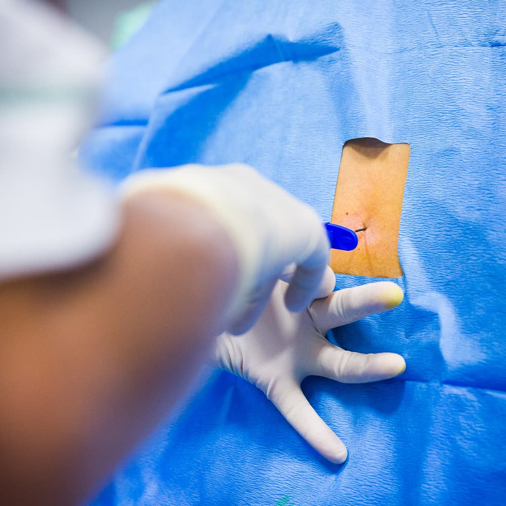 Ofte kan neuroaksial blokade anlægges, også selvom der forekommer ryganomali