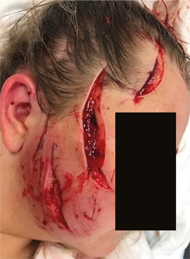 Traumatisk læsion. Billedet er gengivet med patientens tilladelse.