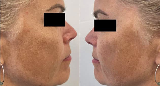 Klassisk udbredelse af melasma med symmetrisk udbredelse af makulær hyperpigmentering på kinderne.