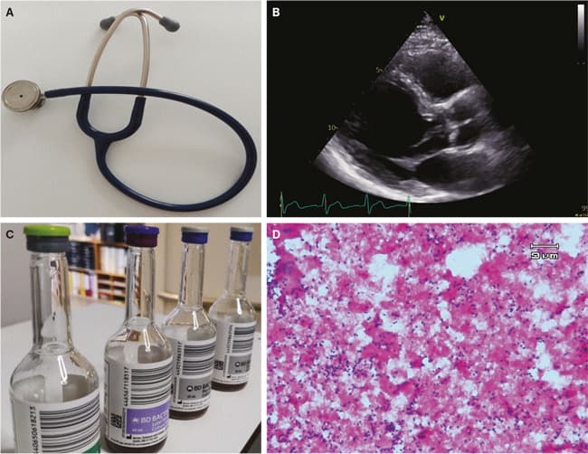Infektiøs endokarditis. A. Klinik. B. Ekkokardiografi. C. Bakteriæmi. D. Pneumokokker i hjerteklappræparat.
