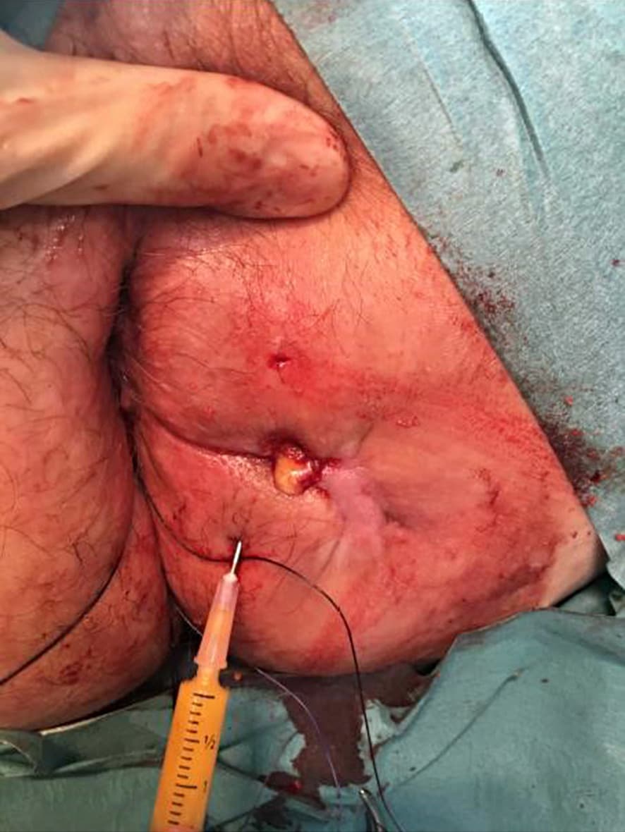 Injektion af stamceller.