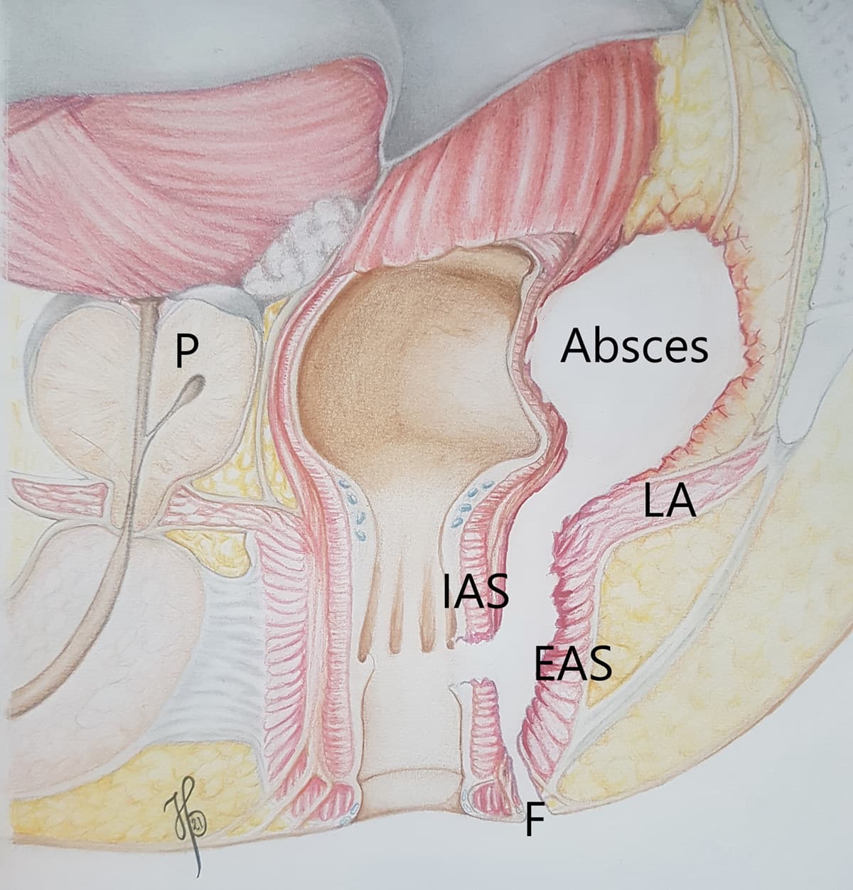 Sagittalsnit af absceslokalisation. EAS = eksterne analsphinkter; F = fistel; IAS = interne analsphinkter; LA = levator ani; P = prostata.
