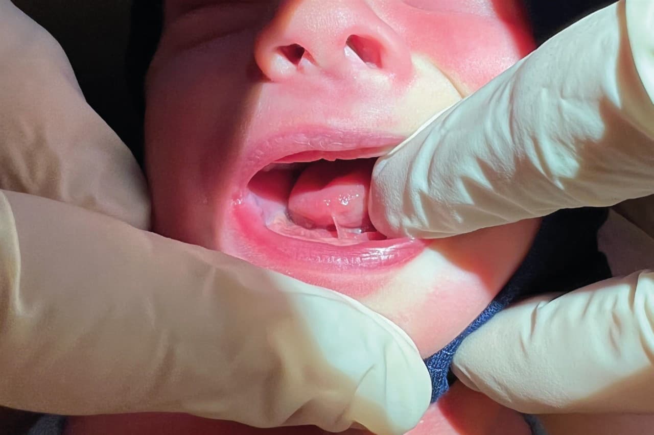 Infant boy (eight days old) with severe ankyloglossia (tongue-tie and breastfed babies assessment score = 0) undergoing lingual frenotomy. Foto: © Jonas Peter Holm, private ENT specialist.