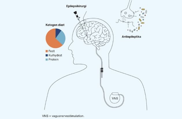 Oversigt over mulighederne for behandling af epilepsi