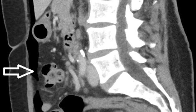 CT viser fri luft fortil i abdomen