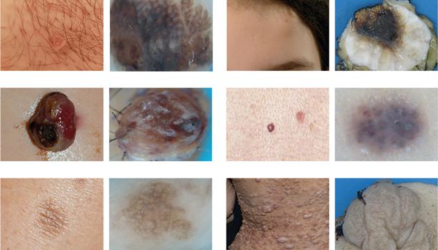 Kliniske og dermatologiske/patologiske billeder af benigne hudforandringer