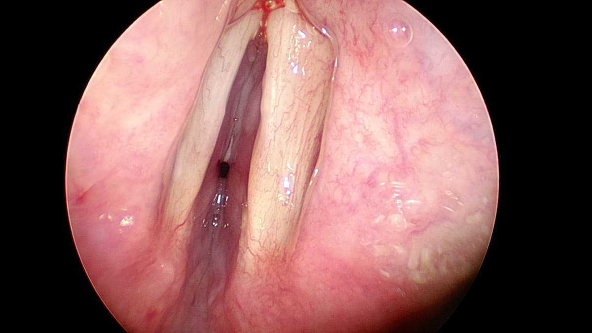 Subglottisk trakealstenose før ballondilatation.