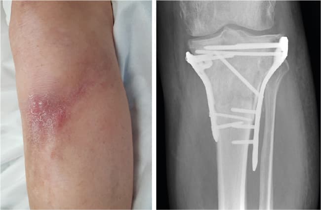 Tremånederskontrol efter operation med skinne og skruer for en proksimal tibiafraktur. Klinisk rødme og hævelse af cikatricen og radiologisk osteolytiske forandringer ved den laterale skinne. Ingen af fundene er bekræftende for en frakturrelateret infektion.