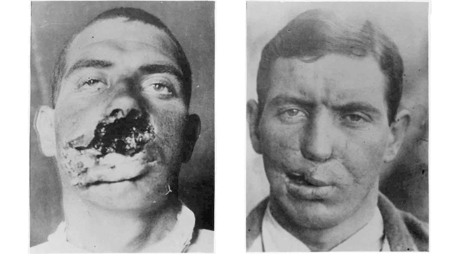 Den moderne plastikkirurgis »far« Harold Gillies og hans kolleger udførte mere end 11.000 operationer på flere end 5.000 patienter under første ­verdenskrig. Han udviklede banebrydende nye teknikker. Fotos: Gillies’ klinik, 1916