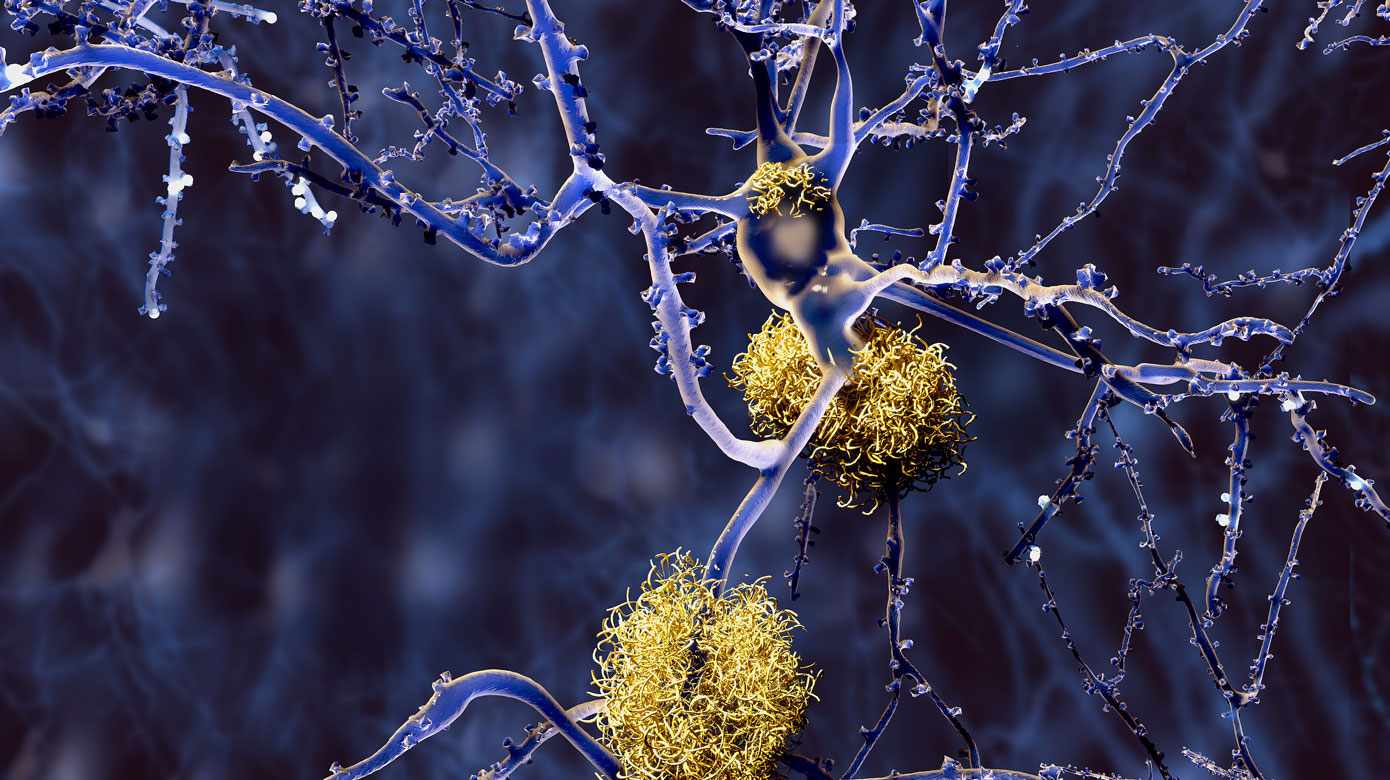 Proteinet amyloid hober sig op i hjernen og bliver til store klumper – plaques (tv). Studier tyder på, at det forsinker ­sygdomsudviklingen, hvis man fjerner amyloid-ophobninger, så hjernen er helt fri for for dem (th). Illustration: Bigstockphoto.