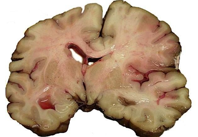 Hjerneblodprop (Foto: Wikimedia Commons)