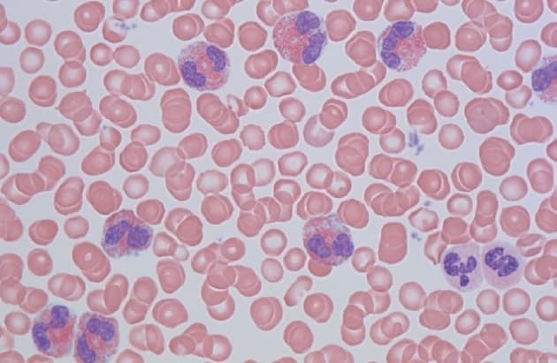 © Udstryg af perifert blod fra en patient med sekundær (reaktiv) eosinofili. (Foto: Michael Boe Møller).