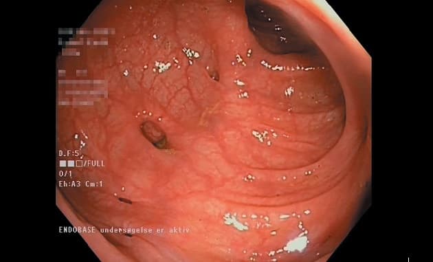 ©. Divertikulose ved endoskopi.
