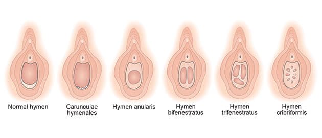 Hymen er en slimhinderand omkring skedeåbningen. Meget få har en hinde, der dækker fuldstændigt. Hymen er ofte halvmåneformet, men kan også være hullet og strengformet. Illustration: Birgitte Lerche-Barlach.