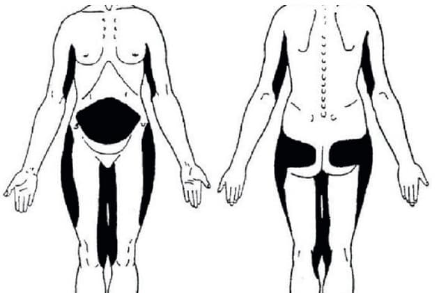 © Smertefuldt fedtvæv ved morbus Dercum. Med tilladelse fra Håkan Brorson, Lunds Universitet