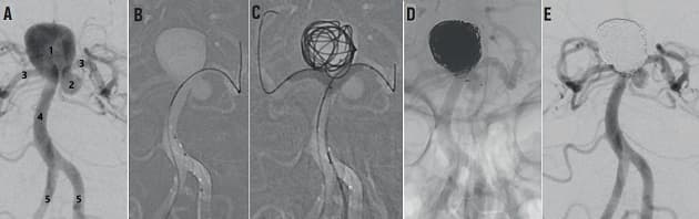 © Digital subtraktionsangiografi, der illustrerer endovaskulær behanding af subaraknoidalblødning.