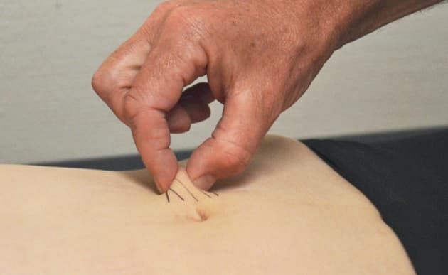 Pinch test - gengivet med tilladelse ©