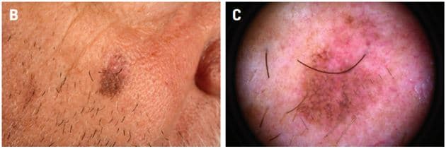 Vekslende pigmenteret tumor (10 × 7 mm) på højre kind hos en 73-årig mand.