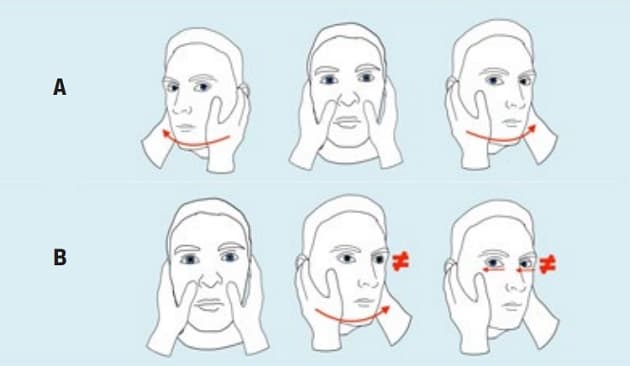Udddrag af head impulse test (HIT)