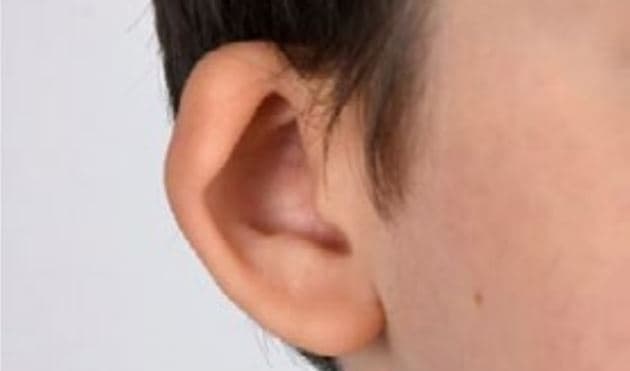 Constricted ear, højresidig, svær grad. Gengivet med patienten/forældrenes tilladelse.