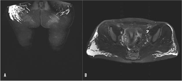 MR-skanningsbilleder af glutealområdet med væskeforandringer i begge baller (A) og på bagsiden af begge lår (B).