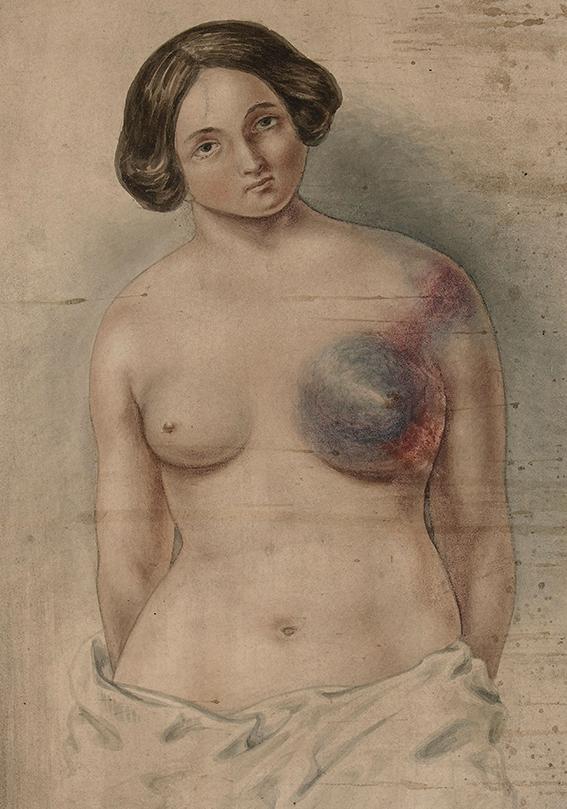 Kvinde med ubehandlet brystkræft. Engelsk akvarel, ca. 1840. Ill.: The Wellcome Collection.