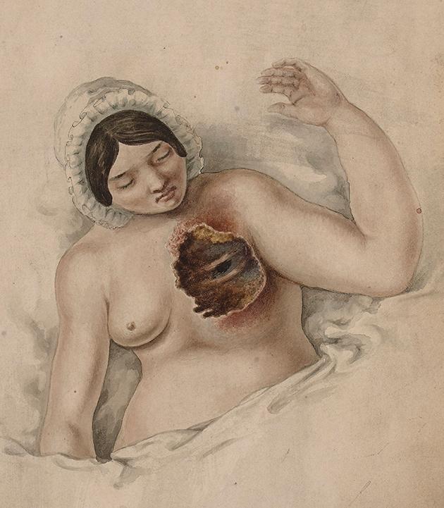 Kvinde med ubehandlet kræft. Ulceration og nekrose har blotlagt muskler og ribben. 1828. Ill.: St Bartholomew's Hospital Archives & Museum // Wellcome
