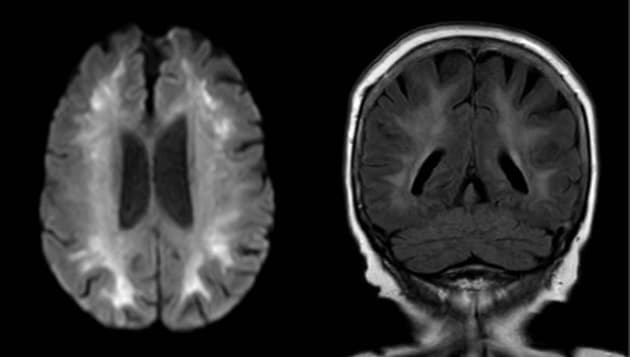 MR skanning af hjernen.