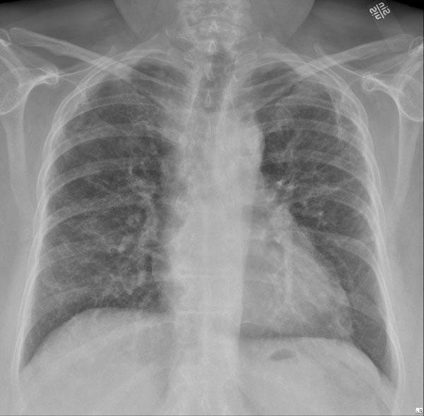 På billedet ses spredte lungeforandringer hos en patient med COVID-19. Billedet er taget 6 uger efter udskrivelsen. Kilde: Infektionsmedicinsk afdeling, OUH.  