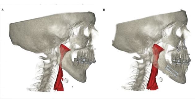 Maxillomandibular avancering kan føre til en signifikat udvidelse af de øvre luftveje. A: Præoperativt. B: Postoperativt.