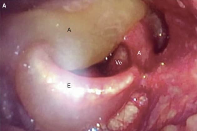 Fleksibel laryngoskopi umiddelbart efter indlæggelse.
