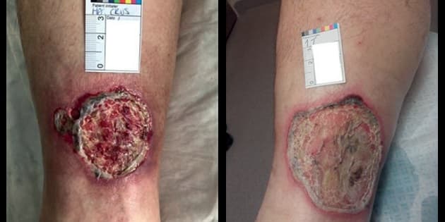 Klassisk ulcerativ pyoderma gangraenosum i forværring. ©