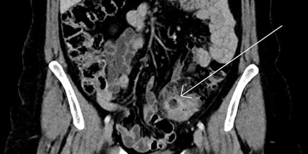 CT-billede af ukompliceret divertikulitis i colon sigmoideum med lokal inflammation og stranding omkring et divertikel (pil).