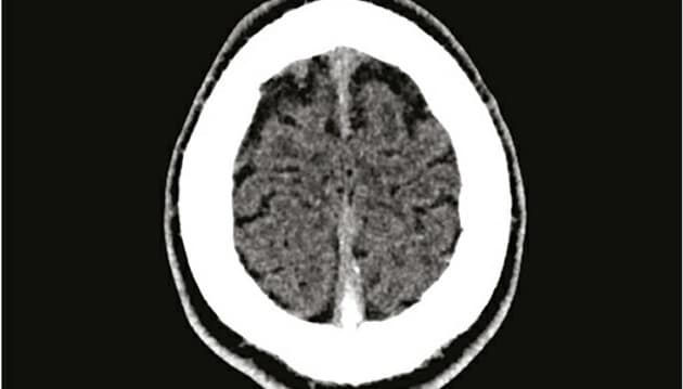 Patientens trombose var så stor, at den kunne ses på et CT-billede af cerebrum uden kontraststof.  Ugeskr Læger 2021;183:V06210511