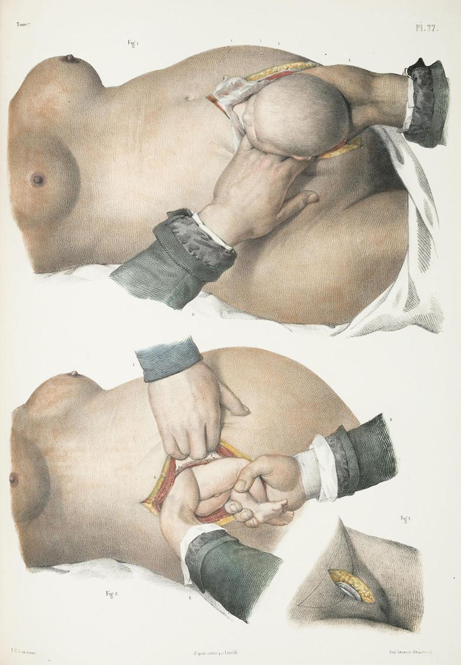 Fremgangsmåde ved kejsersnit. Planche fra 1800-tallet. (Illustration: National Library of Medicine)