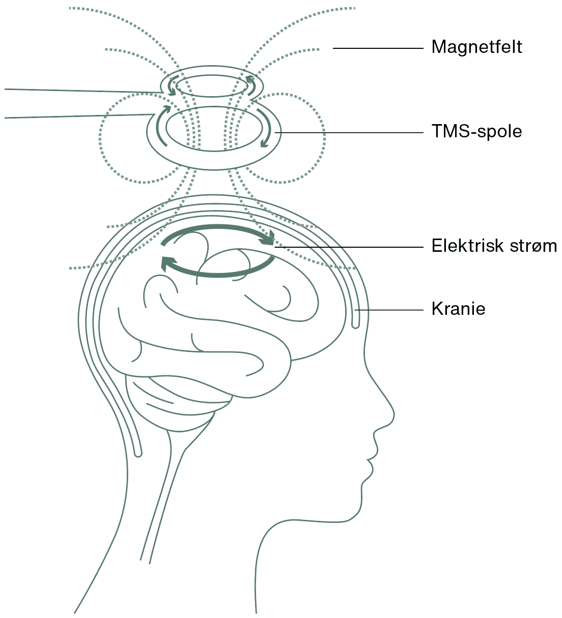 En stor magnetspole placeres få centimeter over hjernens frontallapper. Når der ledes strøm til spolen, danner den et magnetisk felt ned gennem kraniet, som påvirker hjernen gennem elektriske impulser. Illustration: Creative Zoo