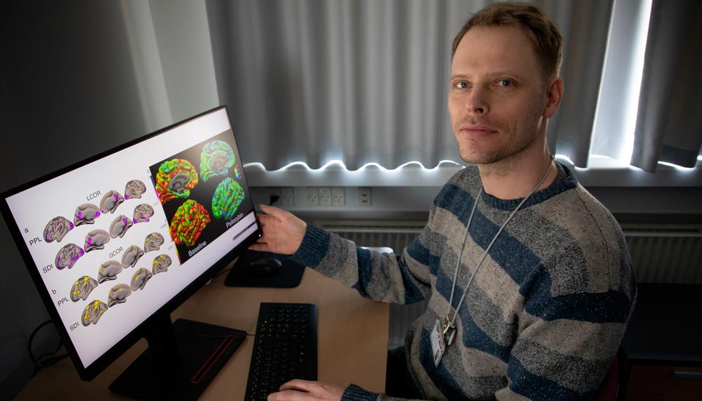 Martin Korsbak Madsen har i et tværfagligt samarbejde på Neurobiologisk Forskningsenhed, Rigshospitalet, afdækket de farmakologiske og neurobiologiske mekanismer ved psilocybin, hvordan stoffet virker i hjernen. 
