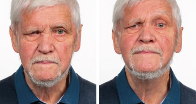 Patient med højresidig øjenbrynsptose efter resektion af hudkræft i højre temporalregion og læsion af rami temporales n. facialis.