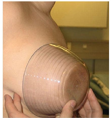 Breast volume measurement using transparent plastic cup.
