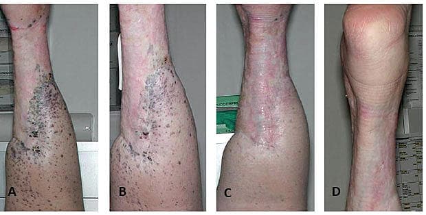 Two and a half years after isolated limb perfusion (ILP), no metastases were visible in the perfused limb.