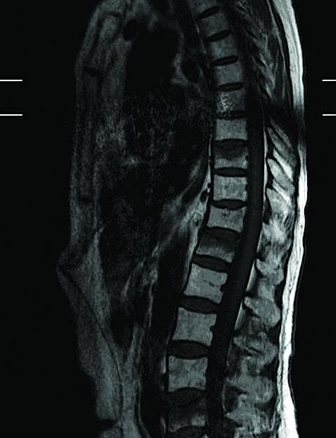 MR-skanning af columna viser kompression af Th9, Th11, Th12 og L4.