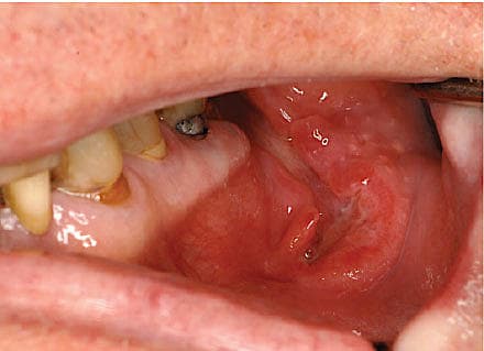 Den orale ulceration hos patienten i sygehistorien.