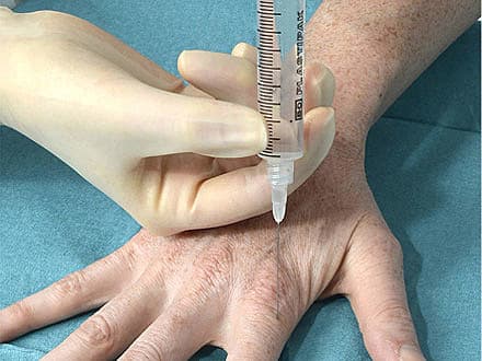 Fingerblok med lokalanæstesi med vasokonstriktor. Foto: Anders Jægenø.