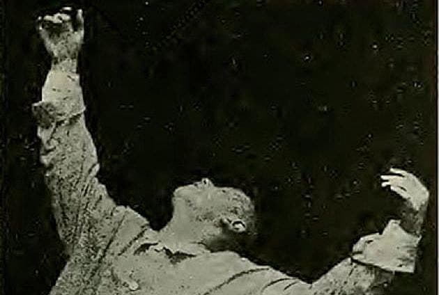 Katatoni. Foto: Emil Kraepelin. (http://imgbuddy.com/catatonic- schizophrenia- waxy-flexibility.asp)